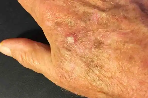 Image of Actinic keratoses Edgware on a person hand